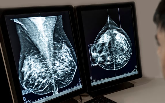 Two side-by-side monitors display detailed mammogram images, with one screen highlighting a zoomed-in area for closer analysis.