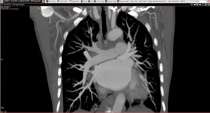 A coronal CT angiography (CTA) scan of the chest displaying detailed visualization of the heart, aorta, and pulmonary vasculature, used for non-invasive assessment of cardiovascular anatomy and disease.
