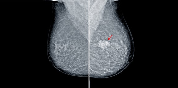 Side-by-side mammogram images of a breast, with a red arrow indicating a suspicious dense area on the right image.