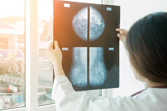 A clinician holds a mammogram film up to a window, examining multiple breast X-ray views in natural light.