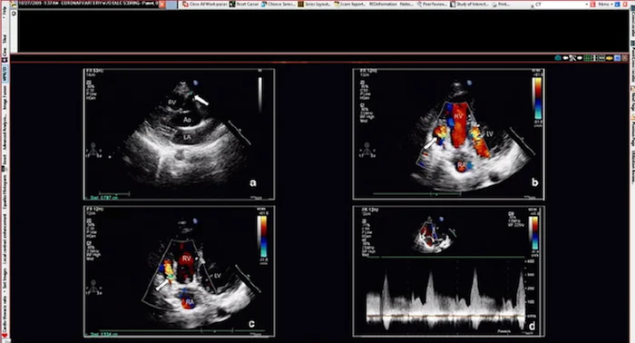 A multi-panel echocardiography workstation display showing four cardiac ultrasound views, including grayscale and color Doppler imaging of the heart's chambers and valves, used for diagnosing pediatric and adult cardiovascular conditions.