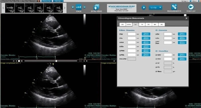 An echocardiogram study shown on the NovaCardio viewer by Novarad