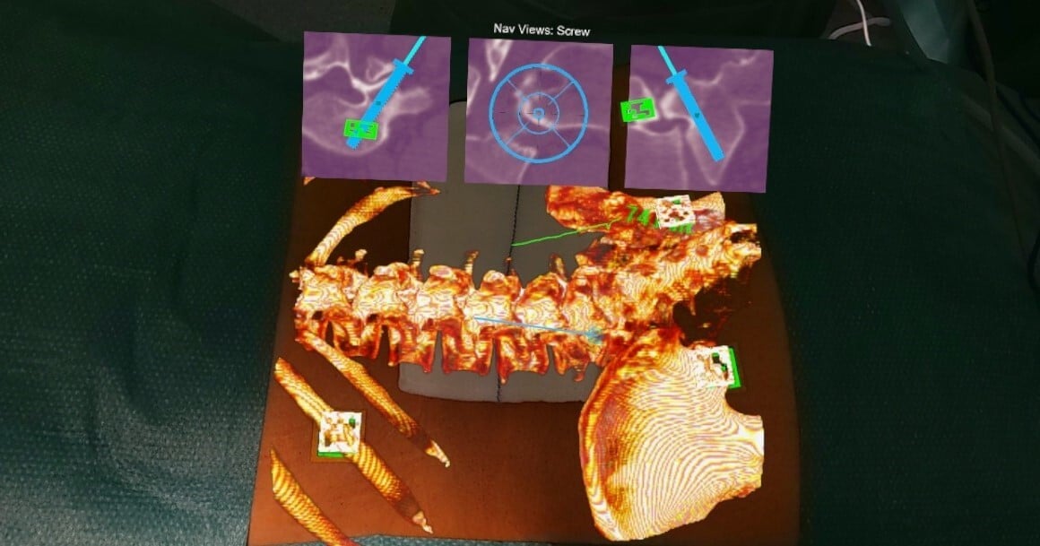 view of spine surgery through the VisAR HoloLens